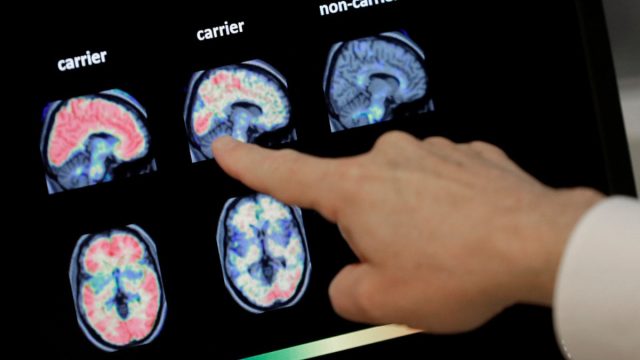 Transformations in Alzheimer's Care: Innovations to Watch Now